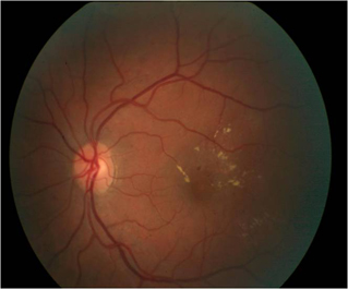 There are two kinds of diabetic retinopathy.